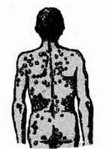 The infection diagram may